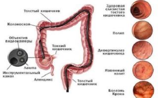 Колоноскопия при варикозе кишечника — назначение, плюсы, минусы