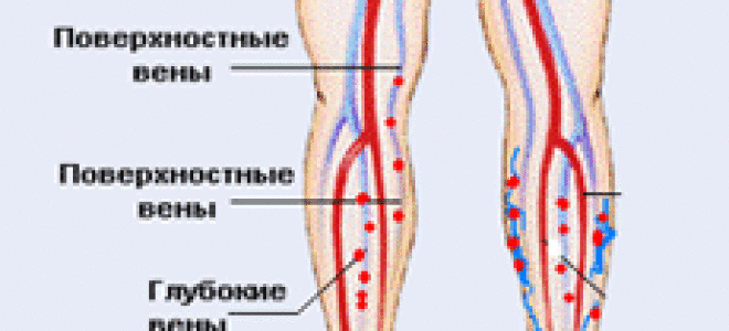 Тромбоз и тромбофлебит полового члена — причины, симптомы