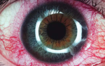 Неоваскуляция радужной оболочки глаза — симптомы,лечение