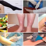 Народные средства от отеков ног при варикозе, методы, рецепты