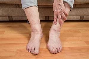 Как проверить сосуды на ногах на тромбы - группы риска, симптомы