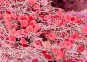 Тромбоэмболия легочной артерии: причины, симптомы, лечение