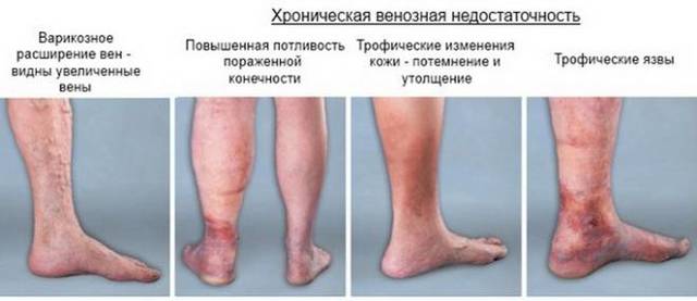 Венозная недостаточность ног: симптомы, лечение, профилактика