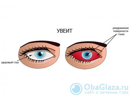 Неоваскуляция радужной оболочки глаза - симптомы,лечение