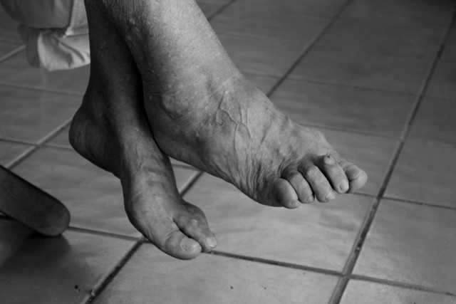 Лечение отеков ног у пожилых народными средствами, рецепты, результаты