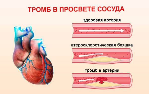 Влияние курения на кровеносные сосуды, заболевания, опасности