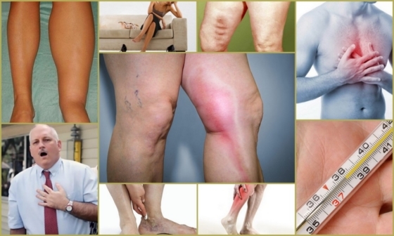 Признаки тромба в ноге, тромбоз, вены, симптомы, последствия