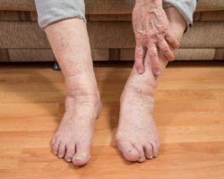 Лечение отеков ног у пожилых народными средствами, рецепты, результаты
