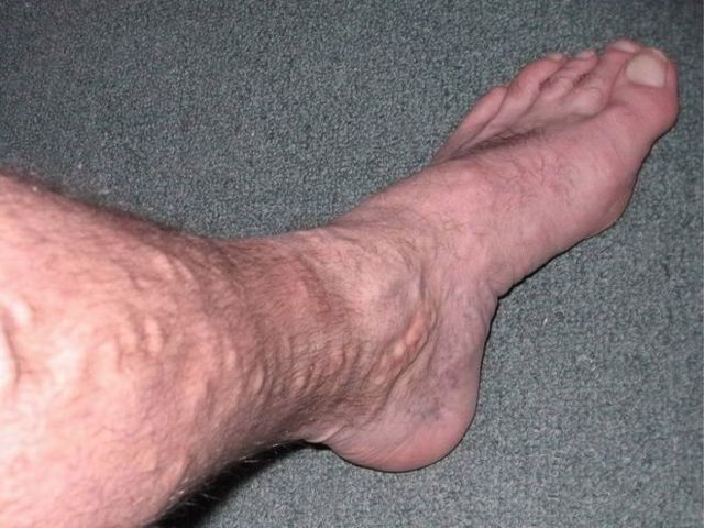 От чего вздуваются вены на ногах, причины, симптомы, методы лечения