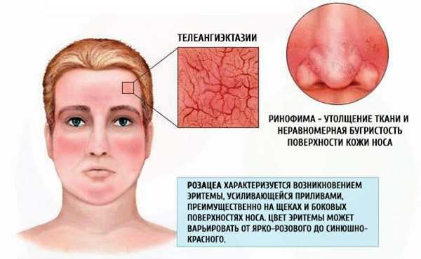 Мази при куперозе на лице - симптомы, диагностика, лечение