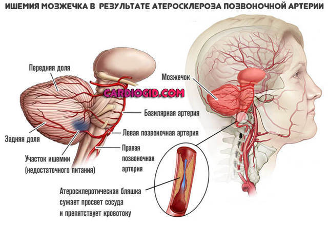 Атеросклероз соудов головного мозга: причины, симптомы, лечение