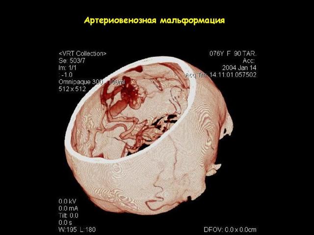 Артериовенозная мальформация - причины, диагностика. лечение