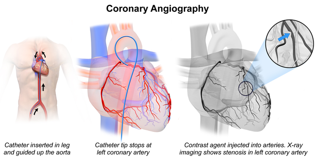 Коронарная артериография: показания и противопоказания