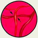 Окклюзия центральной артерии сетчатки причины, симптомы, лечение
