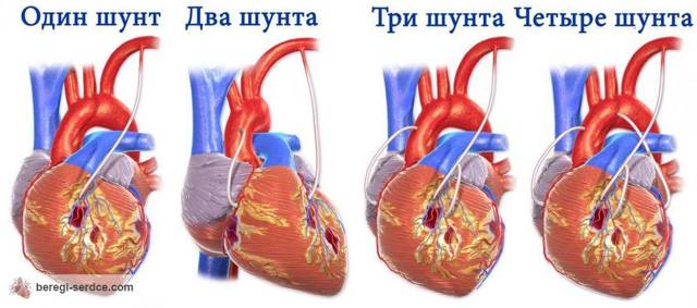 Коронарное шунтирование сердца - показания, техника проведения