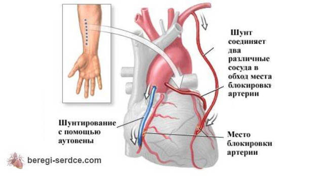 Коронарное шунтирование сердца - показания, техника проведения