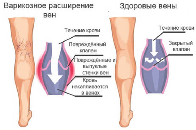 Можно ли замаскировать проявления варикоза на ногах, способы