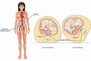 Синдром нижней полой вены: особенности, лечение, профилактика