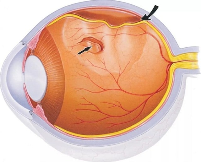 Эмболия сетчатки глаза - симптомы, диагностика, лечение