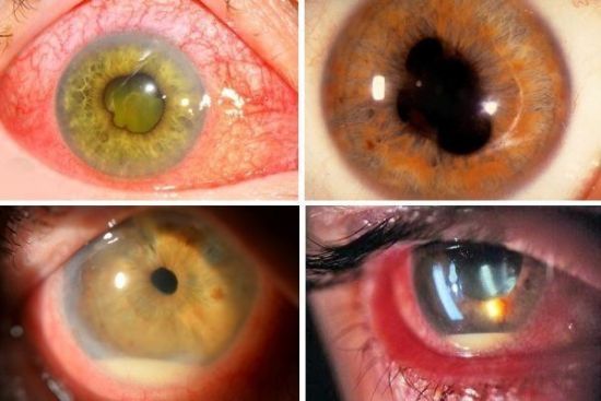 Неоваскуляция радужной оболочки глаза - симптомы,лечение