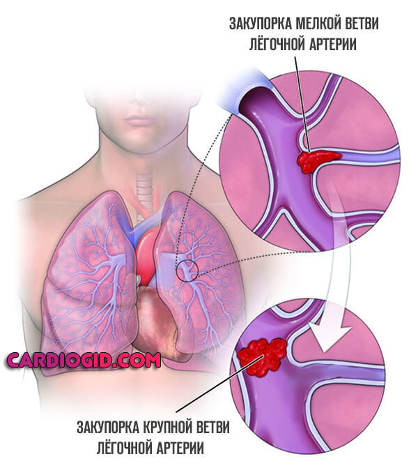 Тромбоэмболия легочной артерии: причины, симптомы, лечение
