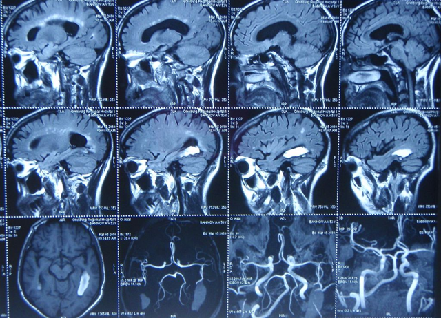 МРТ при заболеваниях сосудов: что это, как проходит