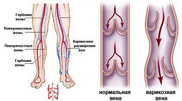 Синие вены на ногах, причины, симптомы, методы лечения, риски