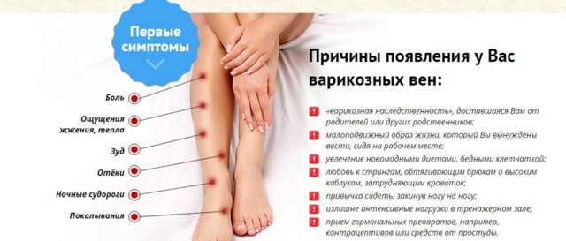 Варикозные узлы на ногах - причины, опасность, методы лечения