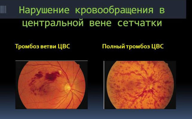 Тромбоз центральной вены сетчатки глаза - причины, симптомы, риски