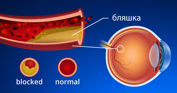 Тромбоз центральной вены сетчатки глаза - причины, симптомы, риски