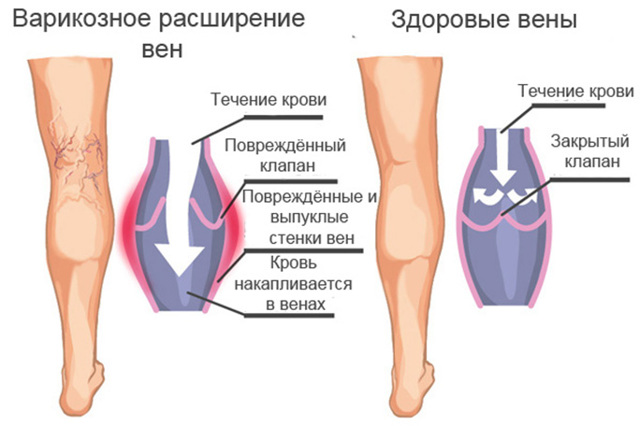 Варикоз - упражнения для ног - польза, когда разрешено, ограничения
