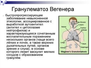 Гранулематоз Вегенера - причины, симптомы, диагностика, лечение