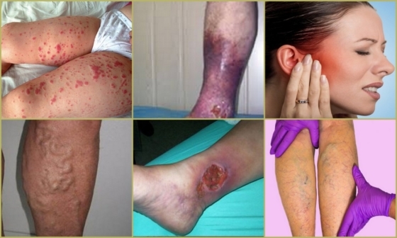 Признаки тромба в ноге, тромбоз, вены, симптомы, последствия