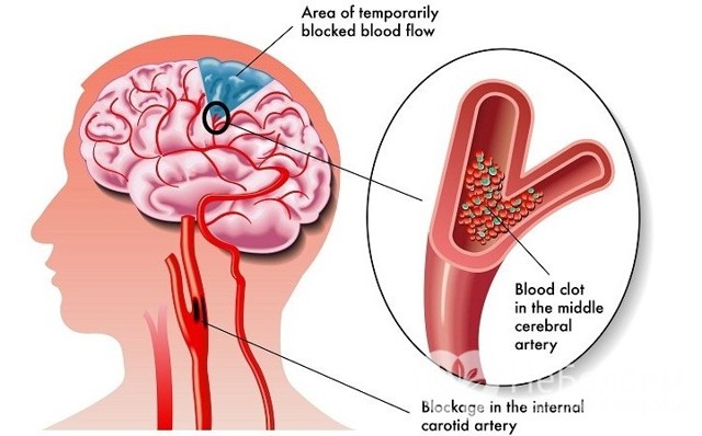 Атеросклероз соудов головного мозга: причины, симптомы, лечение