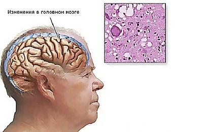 Вены головного мозга, анатомия, строение, функции, заболевания вен мозга